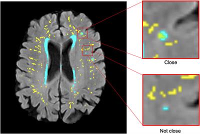 Topological relationships between perivascular spaces and progression of white matter hyperintensities: A pilot study in a sample of the Lothian Birth Cohort 1936